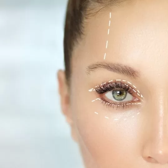 Blepharoplasty 1 jpg