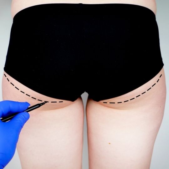 Buttocks Reduction Surgery in Turkey