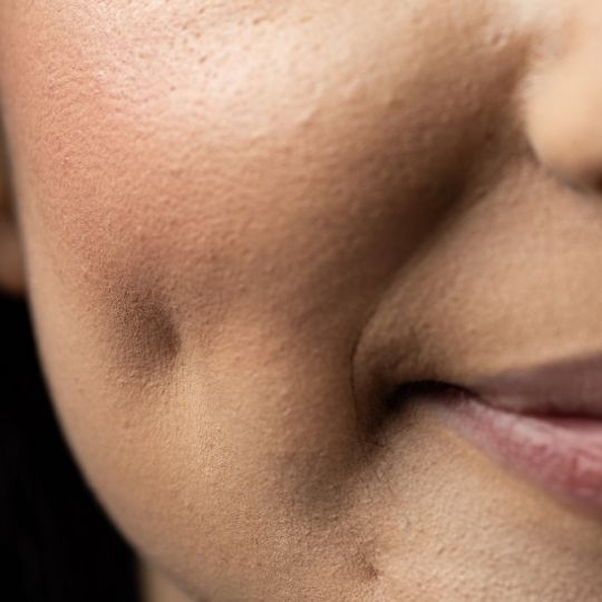 Dimple Surgery in Turkey