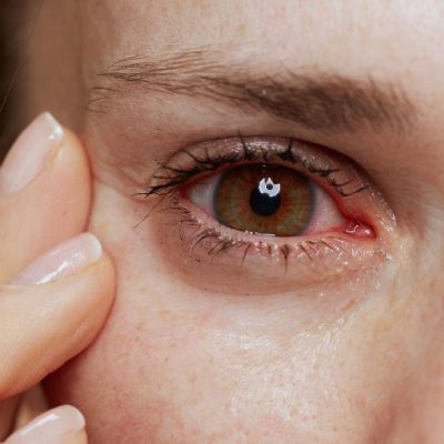 Glaucoma Eye Pressure Treatment In Turkey