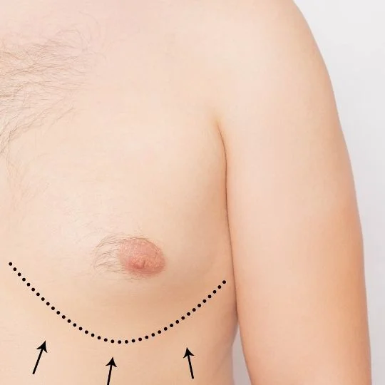 Gynecomastia COST REVIEWS IN IZMIR TURKEY 2