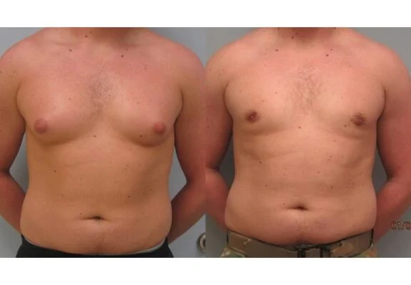 GynecomastiaBA 1