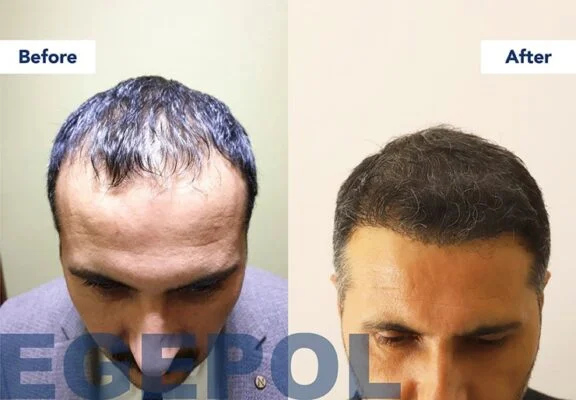 HairTransplant1