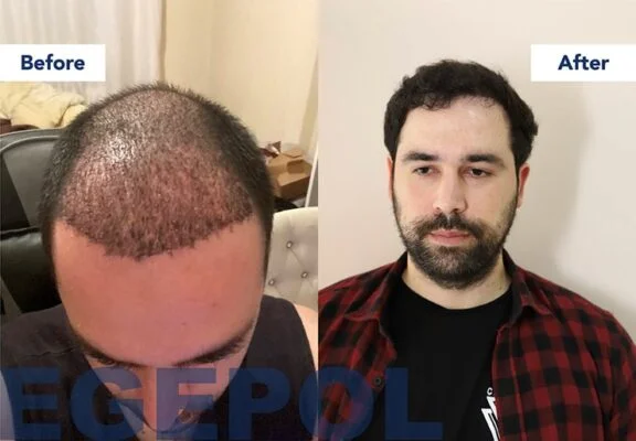 HairTransplant2