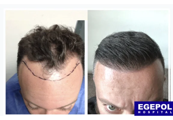 HairTransplant4