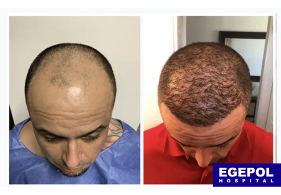 HairTransplant5