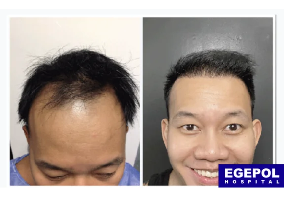 HairTransplant6