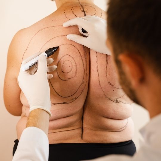 Laser Liposuction in Turkey