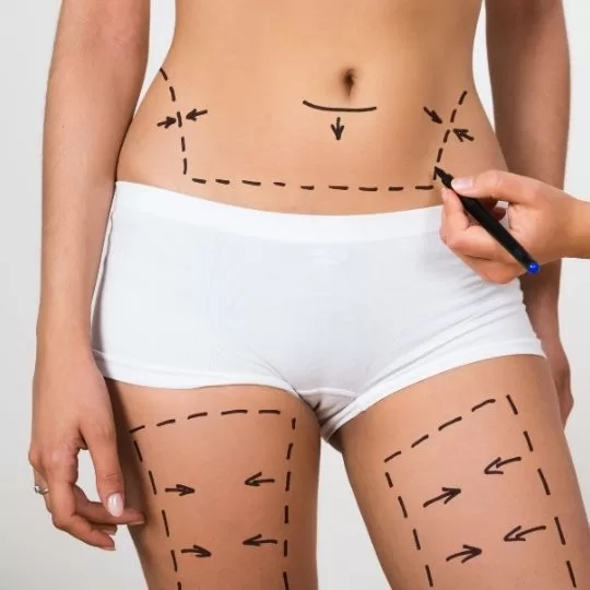 Liposuction jpg