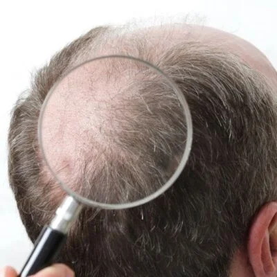 Mega Session Hair Transplant Cost Reviews In Izmir Turkey 1