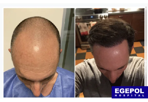 MegaSessionHairTransplant3 1