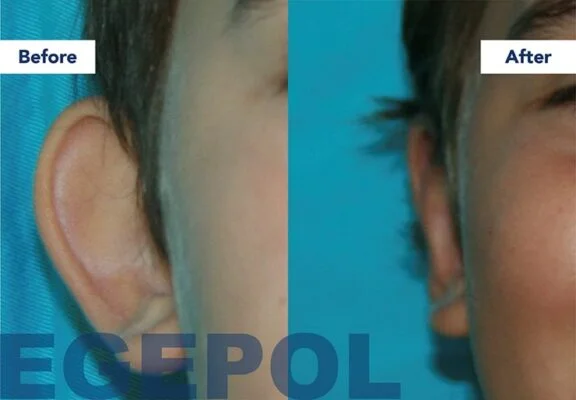 Otoplasty2 1