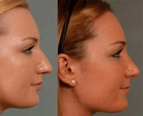 Rhinoplasty10 1