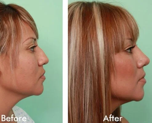 Rhinoplasty5 1