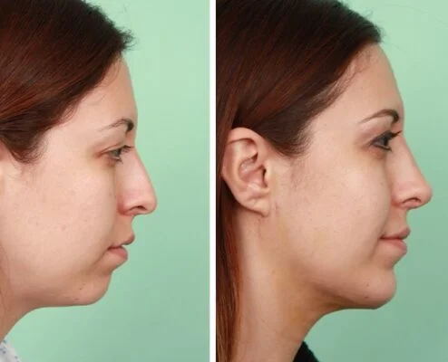 Rhinoplasty7 1