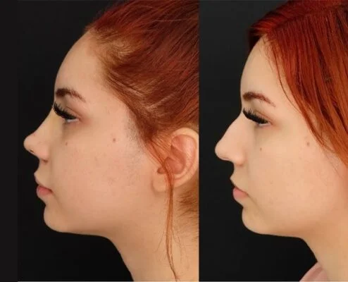 Rhinoplasty9 1