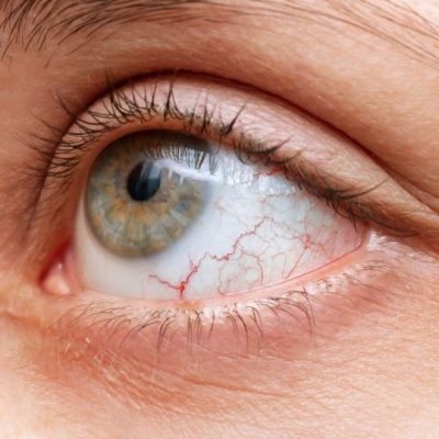 Uveitis Treatment in Turkey